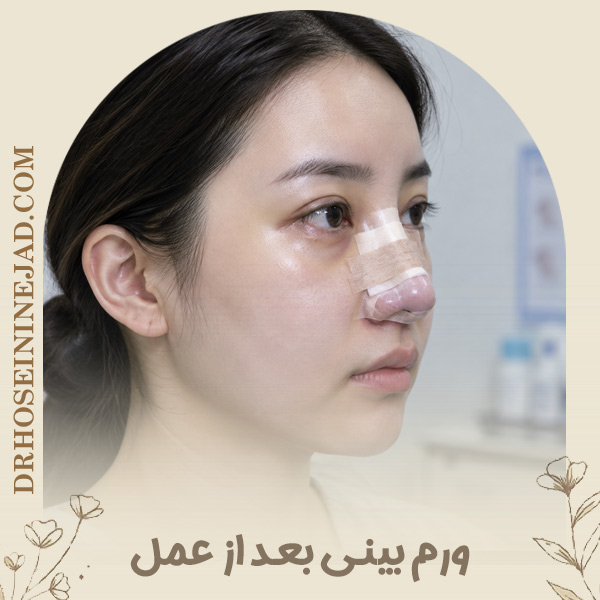 ورم بینی بعد از عمل -دکتر حسینی نژاد