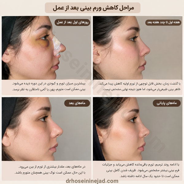 ورم بینی بعد از عمل -دکتر حسینی نژاد