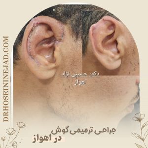 جراحی بازسازی گوش با غضروف - دکتر حسینی نژاد
