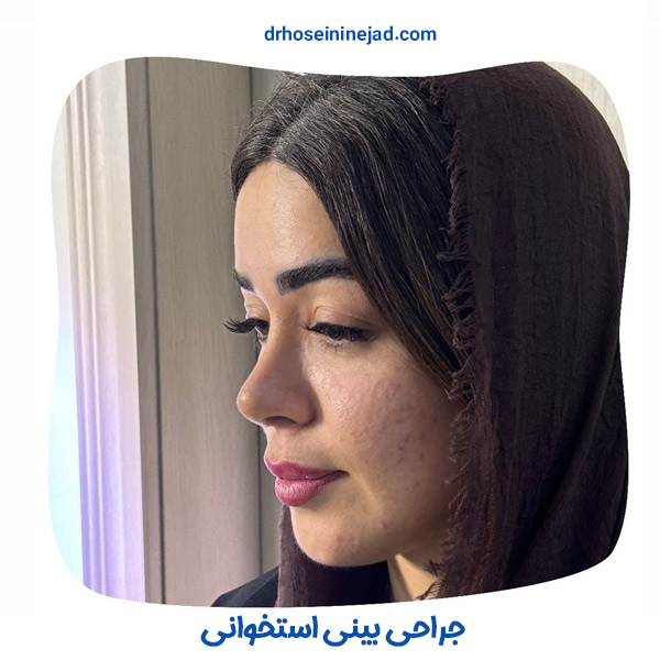 عمل بینی استخوانی - دکتر حسینی نژاد