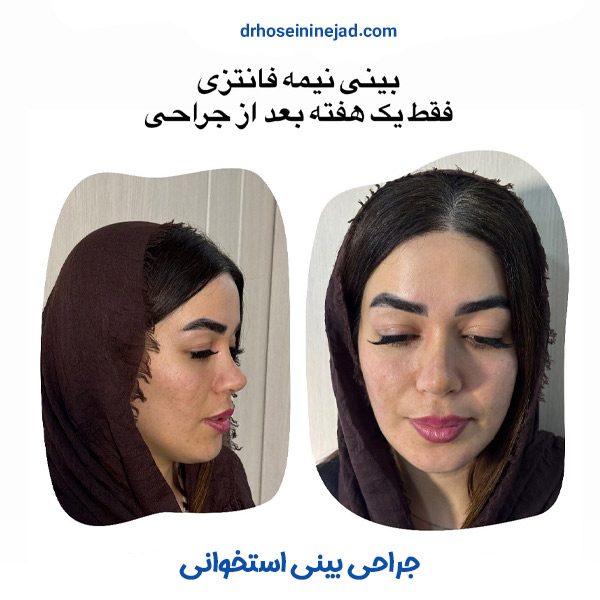 عمل بینی استخوانی - دکتر حسینی نژاد