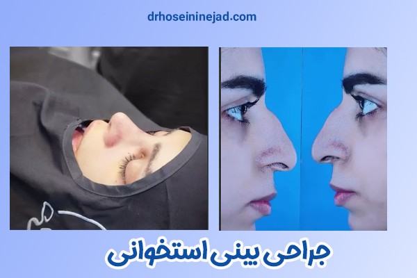 جراحی بینی استخوانی - دکتر حسینی نژاد