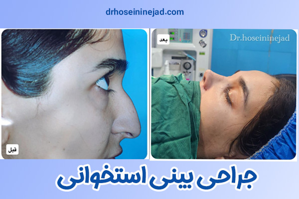 جراحی بینی استخوانی - دکتر حسینی نژاد