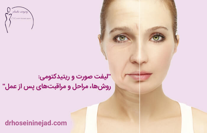 جراحی لیفت صورت - دکتر صاحب حسینی نژاد