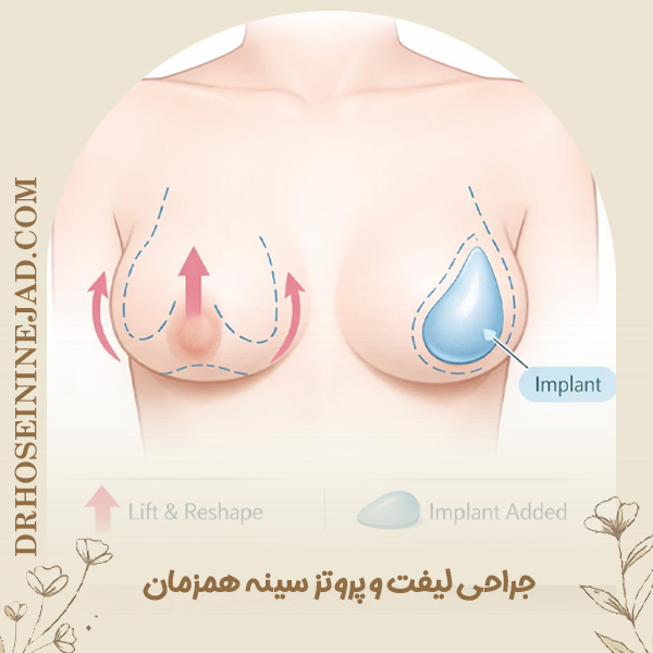 لیفت و پروتز سینه همزمان - دکتر حسینی نژاد
