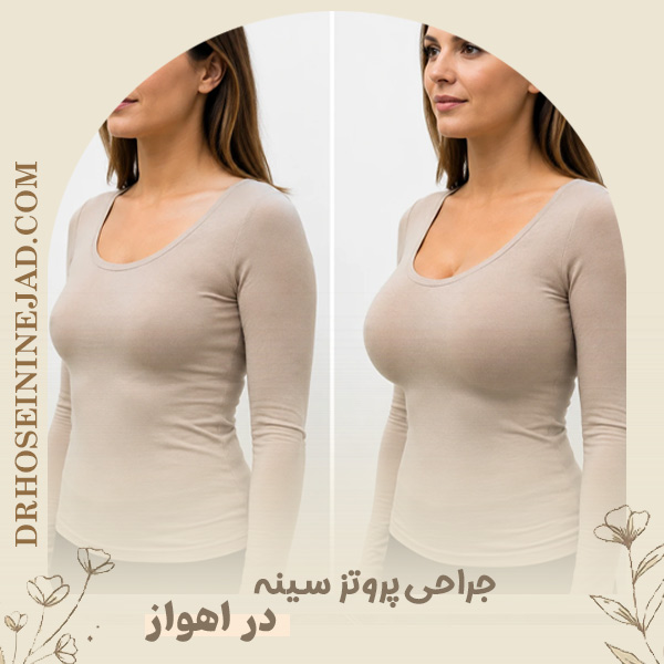 جراحی پروتز سینه در اهواز - دکتر حسینی نژاد