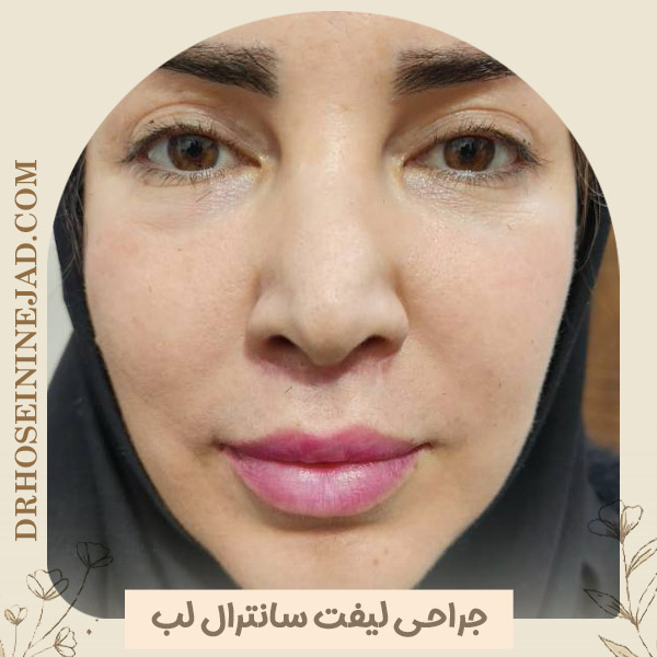 جراحی لیفت سانترال لب در اهواز - دکتر حسینی نژاد