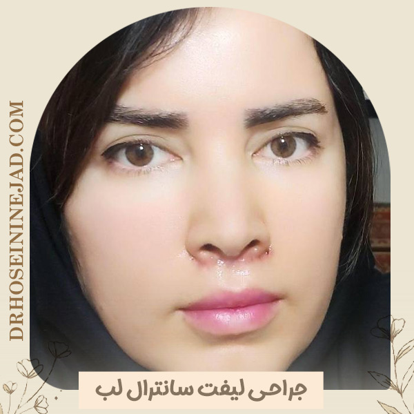 لیفت سانترال لب در اهواز - دکتر حسینی نژاد