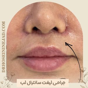 لیفت سانترال لب در اهواز - دکتر حسینی نژاد