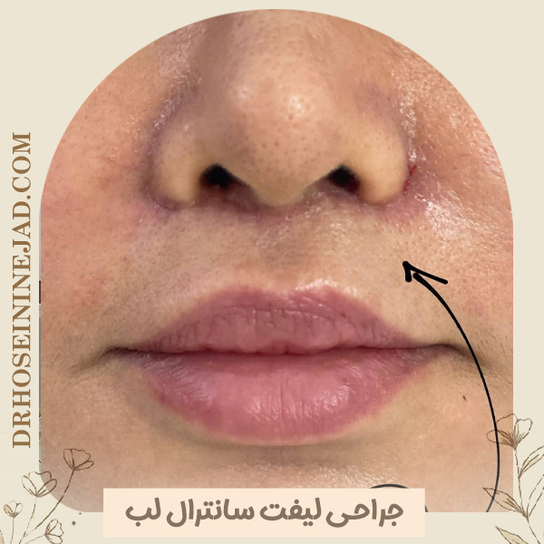 لیفت سانترال لب در اهواز - دکتر حسینی نژاد