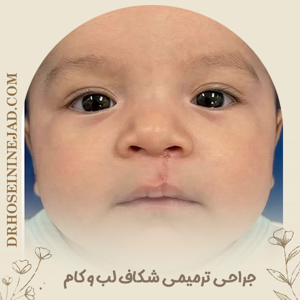 جراحی ترمیمی - شکاف لب و کام - دکتر حسینی نژاد