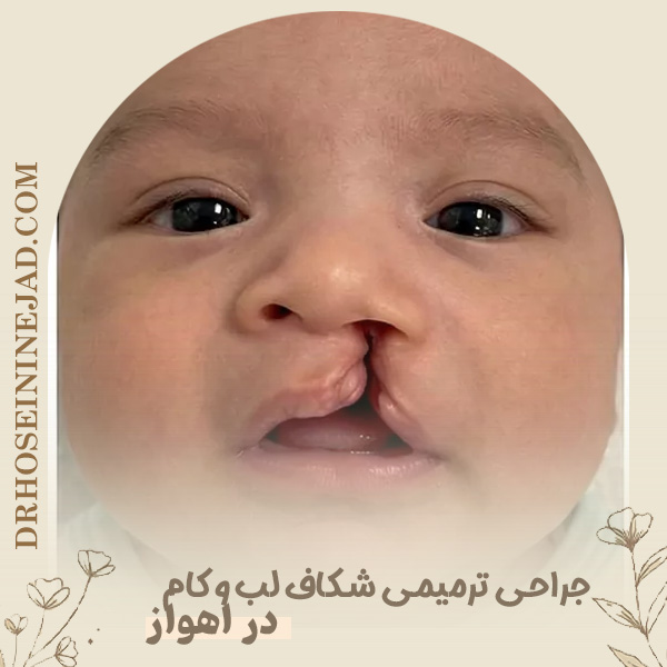جراحی ترمیمی - شکاف لب و کام - دکتر حسینی نژاد