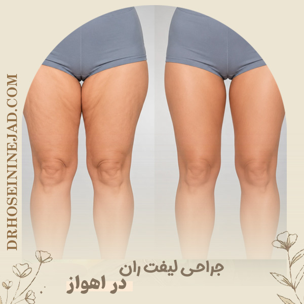 جراحی لیفت ران - دکتر حسینی نژاد