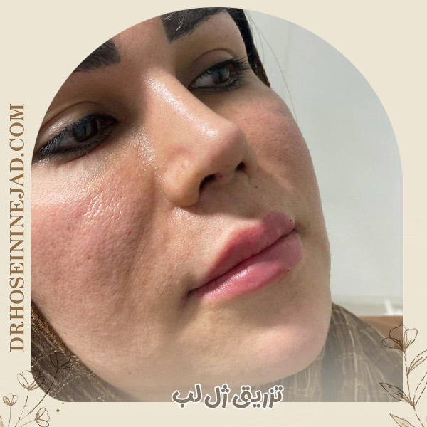 تزریق ژل لب - دکتر حسینی نژاد