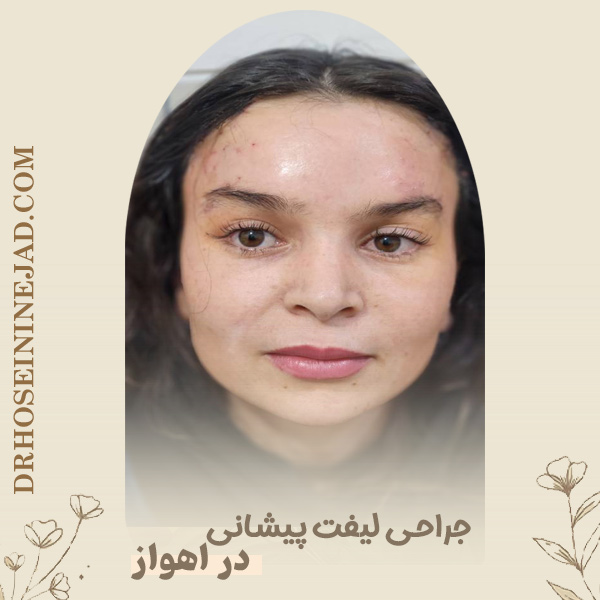 جراحی لیفت پیشانی در اهواز - دکتر حسینی نژاد