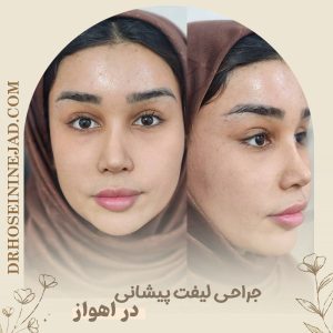 جراحی لیفت پیشانی در اهواز - دکتر حسینی نژاد