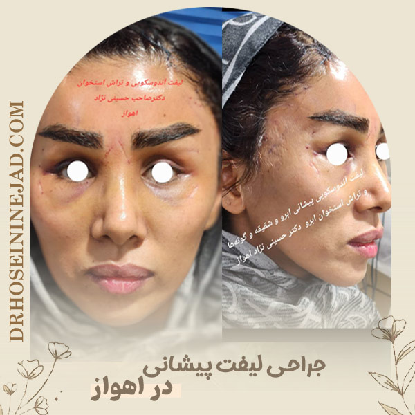 جراحی لیفت پیشانی در اهواز - دکتر حسینی نژاد