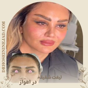 لیفت شقیقه یا تمپورال لیفت - دکتر حسینی نژاد