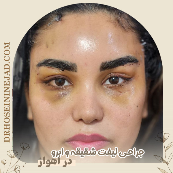لیفت شقیقه - دکتر حسینی نژاد
