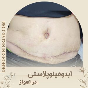 ابدومینوپلاستی با سابقه عمل کیسه صفرا - دکتر حسینی نژاد