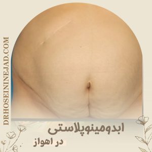 ابدومینوپلاستی با سابقه عمل کیسه صفرا - دکتر حسینی نژاد