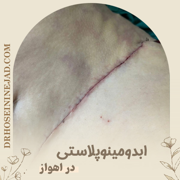 ابدومینوپلاستی در اهواز - دکتر حسینی نژاد