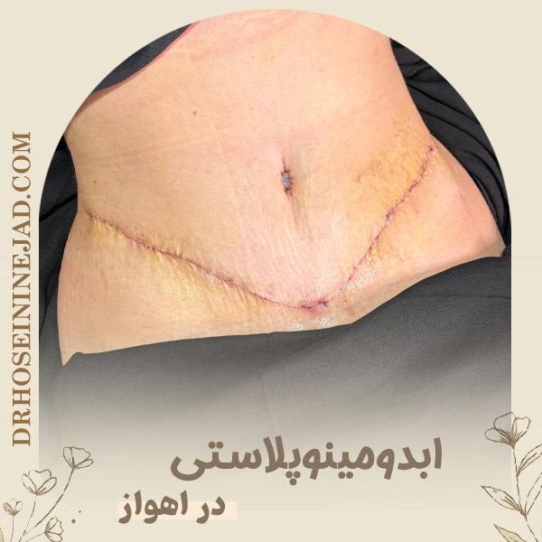 ابدومینوپلاستی در اهواز - دکتر حسینی نژاد