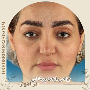 جراحی لیفت پیشانی با دکتر حسینی نژاد