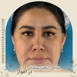 جراحی لیفت پیشانی با دکتر حسینی نژاد