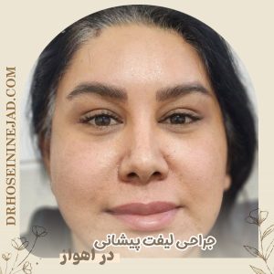 جراحی لیفت پیشانی با دکتر حسینی‌ نژاد 