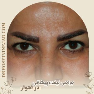 جراحی لیفت پیشانی با دکتر حسینی‌ نژاد 