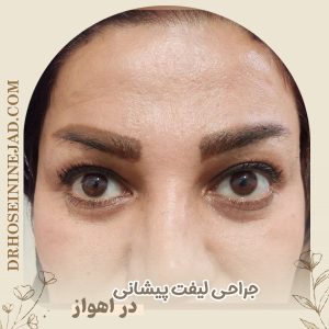 جراحی لیفت پیشانی با دکتر حسینی نژاد