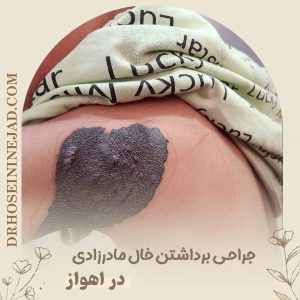 برداشتن خال مادرزادی - دکتر حسینی نژاد