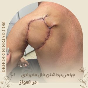 برداشتن خال مادرزادی - دکتر حسینی نژاد