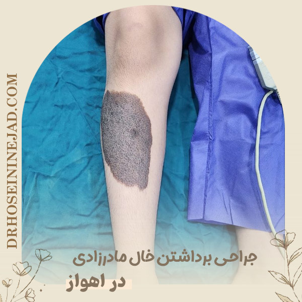 برداشتن خال مادرزادی - دکتر حسینی نژاد
