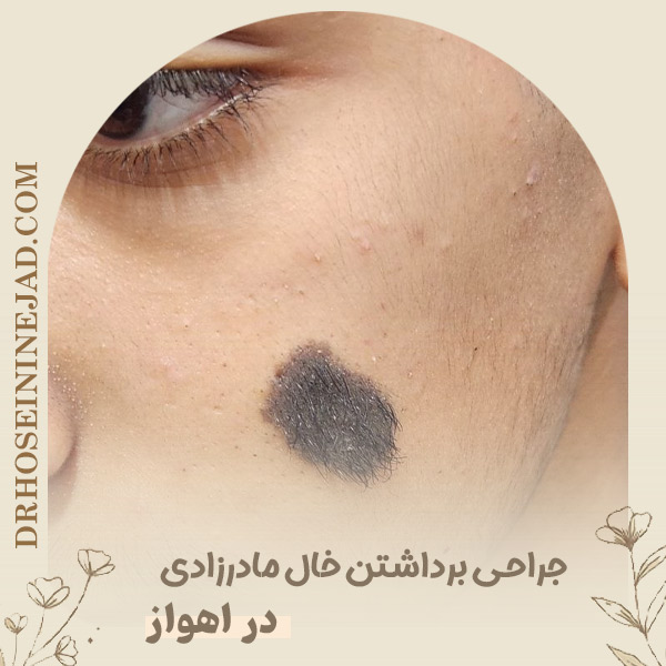 برداشتن خال مادرزادی - دکتر حسینی نژاد