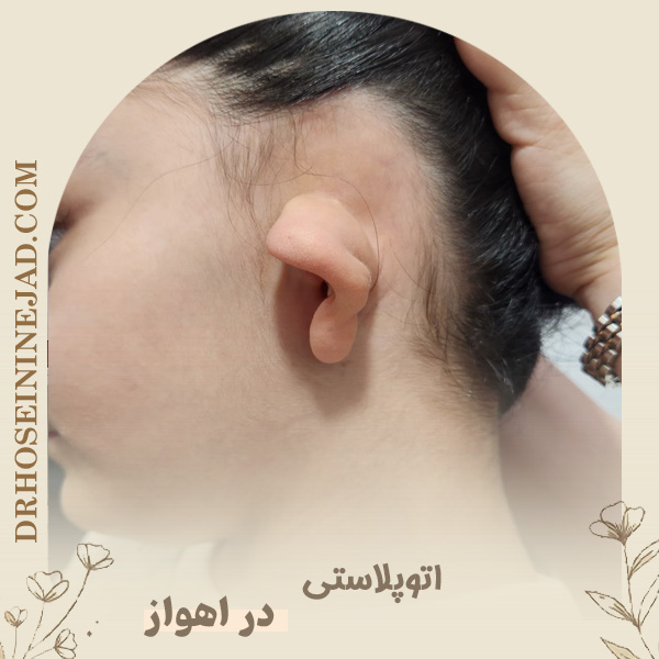 جراحی اتوپلاستی یا اصلاح گوش در اهواز - دکتر حسینی نژاد