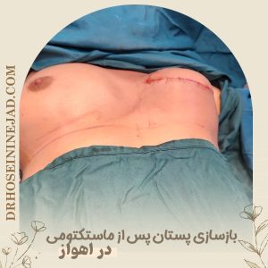 جراحی ترمیمی پستان - دکتر حسینی نژاد
