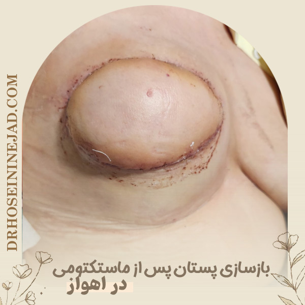 جراحی ترمیمی پستان - دکتر حسینی نژاد