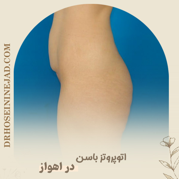 اتوپروتز باسن - دکتر حسینی نژاد