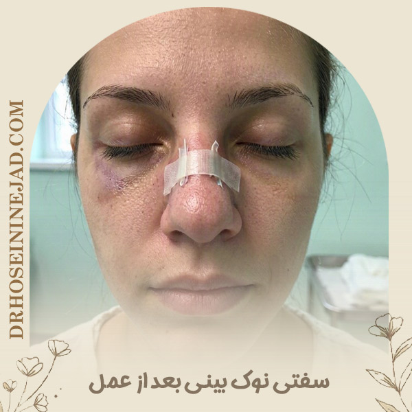 سفتی نوک بینی بعد از عمل - دکتر حسینی نژاد