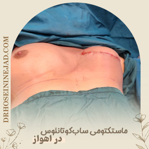 ماستکتومی ساب‌ کوتانئوس - دکتر حسینی نژاد