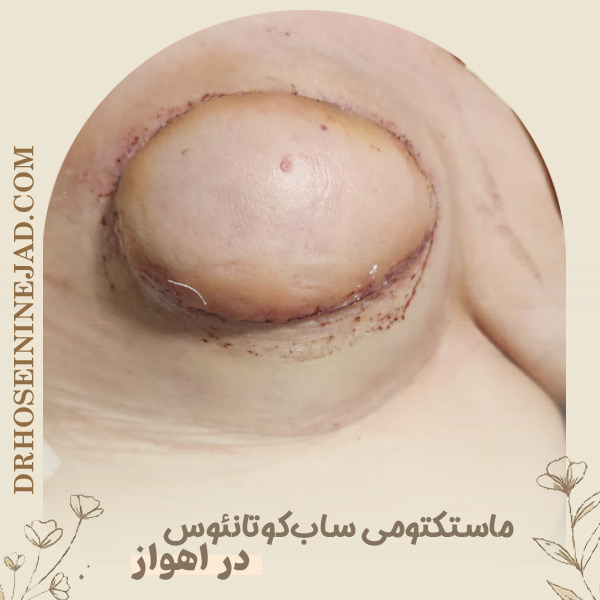 ماستکتومی ساب‌ کوتانئوس - دکتر حسینی نژاد