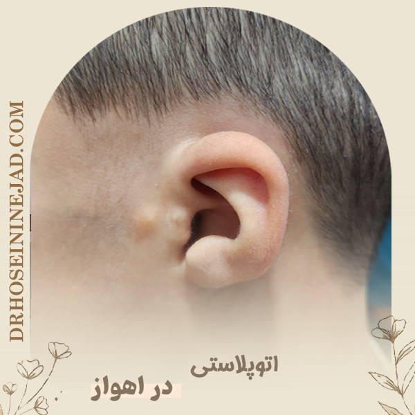جراحی اتوپلاستی یا اصلاح گوش در اهواز - دکتر حسینی نژاد