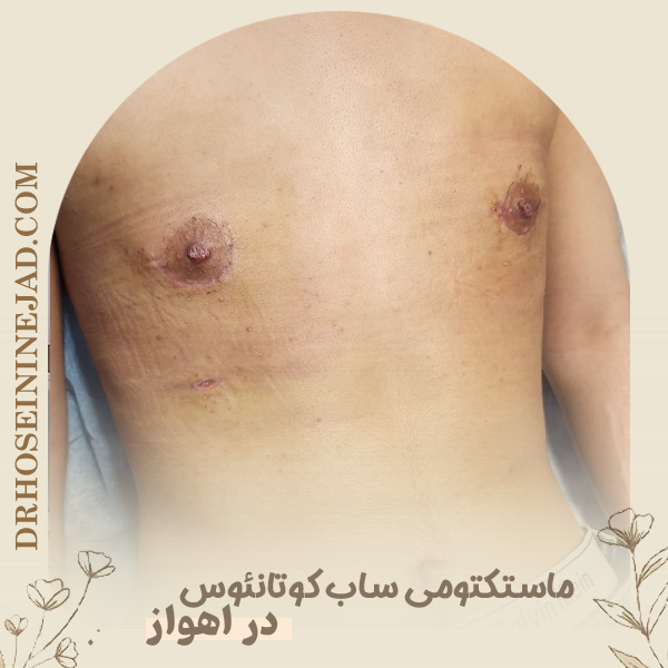 ماستکتومی ساب‌ کوتانئوس - دکتر حسینی نژاد