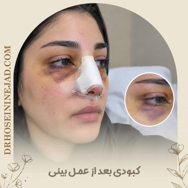 کبودی بعد از عمل بینی - دکتر حسینی نژاد