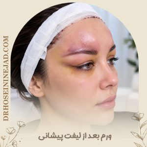 ورم بعد از لیفت پیشانی - دکتر حسینی نژاد