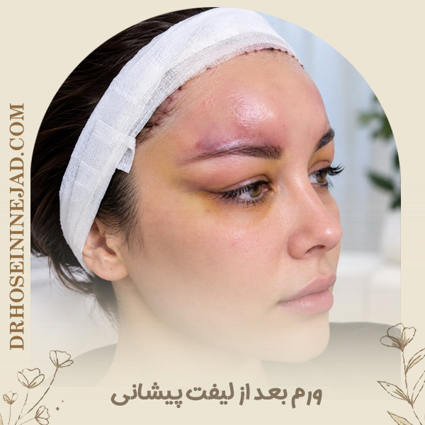 ورم بعد از لیفت پیشانی - دکتر حسینی نژاد